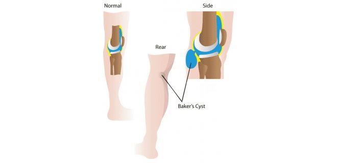 Упражнения при кисте бейкера коленного сустава фото