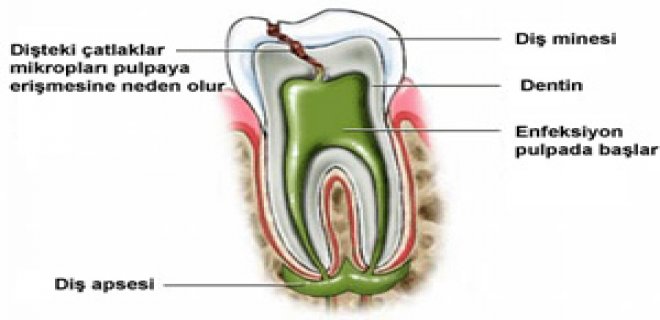 Diş Apsesi Nedenleri ve Tedavi Yöntemleri