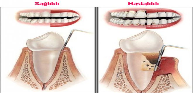 Diş Eti Hastalığı Nedir &amp; Nasıl Tedavi Edilir?
