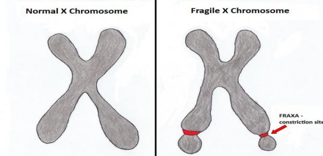 Frajil X Sendromu Pdf