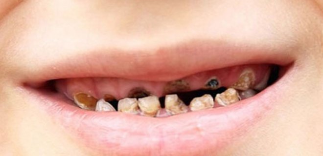 Koruyucu ve Önleyici Ortodonti Tedavi Nedir? &amp; Neler Yapılır?