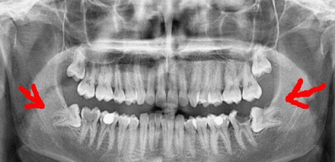 20'lik Diş Nedir ve Nasıl Tedavi Edilir?